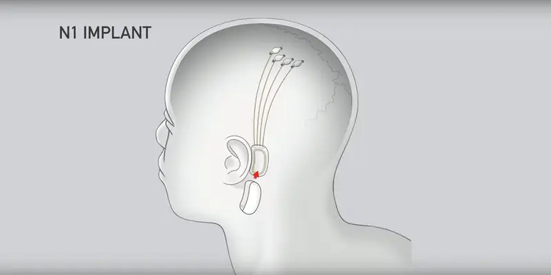 Elon Musk brain implant project Neuralink volunteer