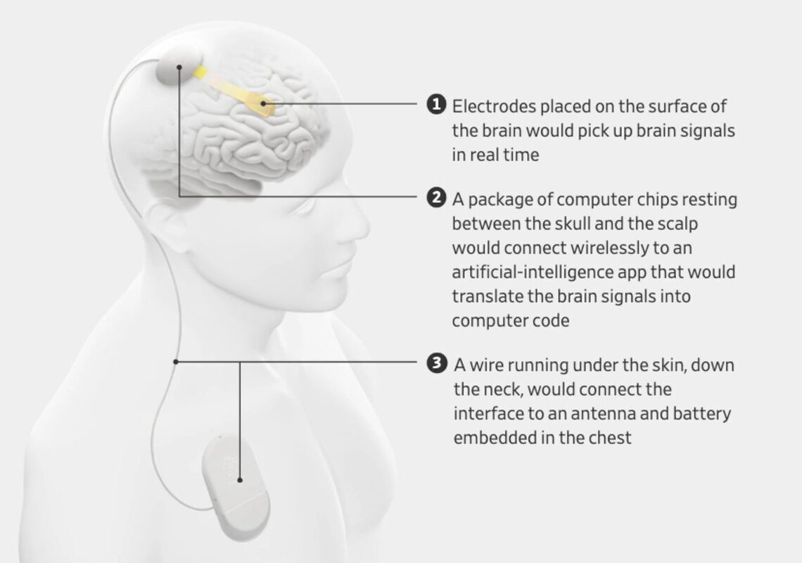 Brain implant restores near-instant speech for paralyzed man